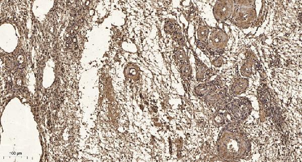 Immunohistochemical analysis of paraffin-embedded human oophoroma