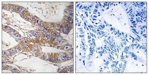 Immunohistochemistry analysis of paraffin-embedded human colon carcinoma tissue, using SERPINB9 Antibody