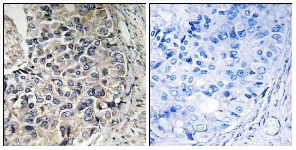 Immunohistochemistry analysis of paraffin-embedded human prostate carcinoma tissue, using CMC1 Antibody