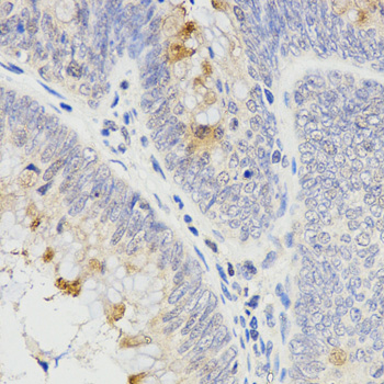 Immunohistochemistry of paraffin-embedded human breast cancer using RAMP2 Rabbit pAb  at dilution of 1:200 
