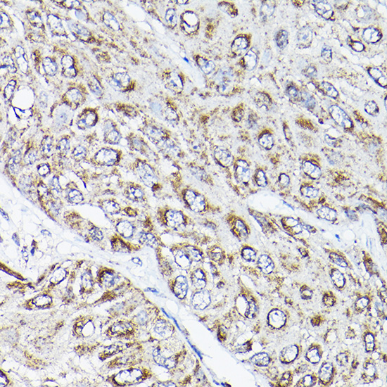 Immunohistochemistry of paraffin-embedded human esophageal cancer using RAMP2 Rabbit pAb  at dilution of 1:200 