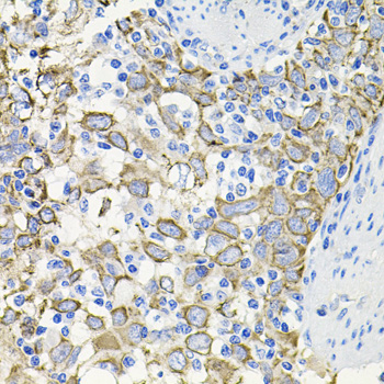 Immunohistochemistry of paraffin-embedded human esophageal cancer using ACVR2A antibody  at dilution of 1:100 