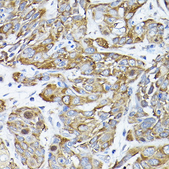 Immunohistochemistry of paraffin-embedded human esophageal cancer using CC2D1A Rabbit pAb  at dilution of 1:200 
