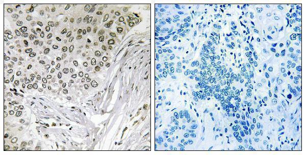 Immunohistochemistry analysis of paraffin-embedded human lung carcinoma tissue, using EFTUD2 Antibody