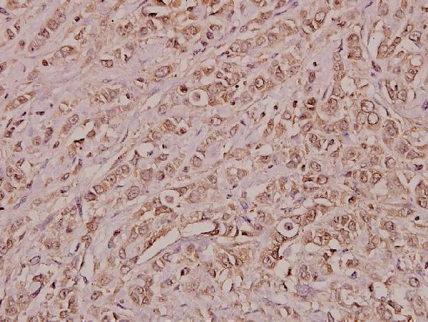 Immunohistochemistry (IHC) analyzes of Annexin III (Y64) pAb in paraffin-embedded human breast carcinoma tissue at 1:100