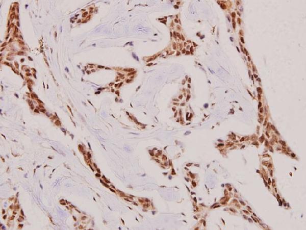 Immunohistochemistry (IHC) analyzes of NIFK (D229) pAb in paraffin-embedded human breast carcinoma tissue at 1:100