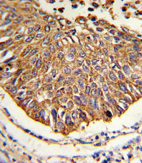 Formalin-fixed and paraffin-embedded human lung carcinoma reacted with MDH2 Antibody (Center), which was peroxidase-conjugated to the secondary antibody, followed by DAB staining. This data demonstrates the use of this antibody for immunohistochemistry; clinical relevance has not been evaluated.