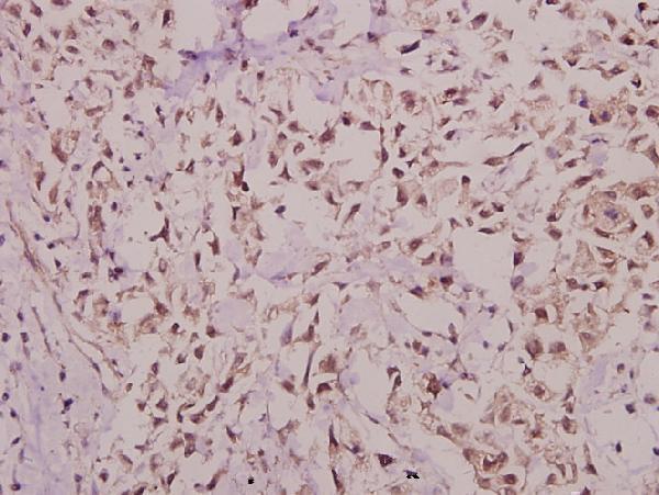 Immunohistochemistry (IHC) analyzes of Hairless (E77) pAb in paraffin-embedded human breast carcinoma tissue at 1:50