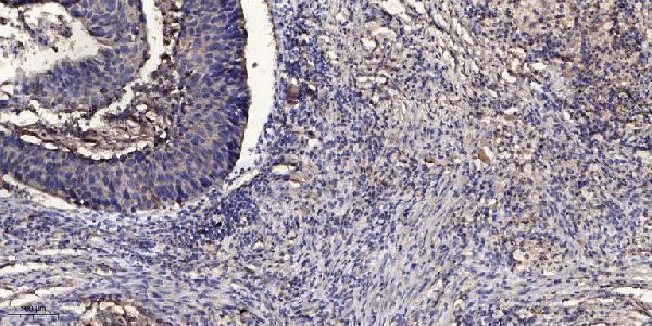 Immunohistochemical analysis of paraffin-embedded human Squamous cell carcinoma of lung