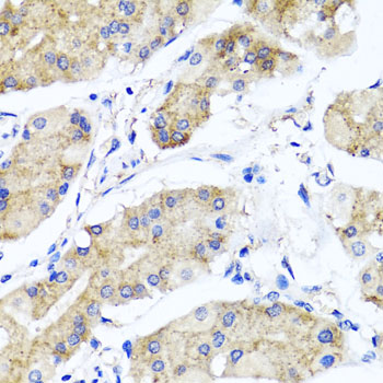 Immunohistochemistry of paraffin-embedded human gastric using PSTPIP1 antibody at dilution of 1:100 (x40 lens)