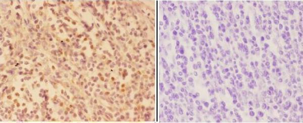 Immunohistochemistry (IHC) analyzes of AKR1A1 pAb in paraffin-embedded human tonsil carcinoma tissue at 1:50,showing cytoplasmic and nuclear staining
