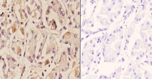 Immunohistochemistry (IHC) analyzes of ZNF42 pAb in paraffin-embedded human stomach carcinoma tissue at 1:50