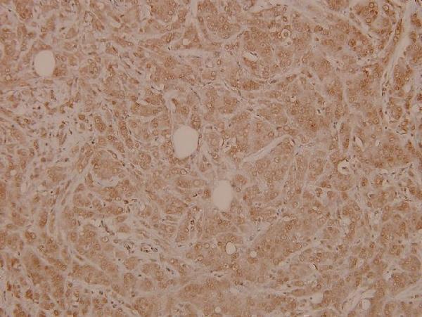 Immunohistochemistry (IHC) analyzes of SLP-76 (G122) pAb in paraffin-embedded human breast carcinoma tissue at 1:100