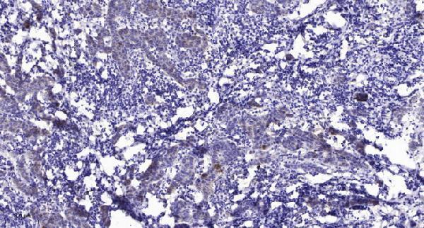 Immunohistochemical analysis of paraffin-embedded human Breast cancer