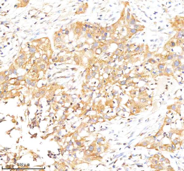 Figure 2. IHC analysis of RAB27B using anti-RAB27B antibody (A04890-1). RAB27B was detected in a paraffin-embedded section of human bladder cancer tissue. Heat mediated antigen retrieval was performed in EDTA buffer (pH 8.0, epitope retrieval solution). The tissue section was blocked with 10% goat serum. The tissue section was then incubated with 2 microg/ml rabbit anti-RAB27B Antibody (A04890-1) overnight at 4°C. Peroxidase Conjugated Goat Anti-rabbit IgG was used as secondary antibody and incubated for 30 minutes at 37°C. The tissue section was developed using HRP Conjugated Rabbit IgG Super Vision Assay Kit (Catalog # SV0002) with DAB as the chromogen. Figure 2. IHC analysis of RAB27B using anti-RAB27B antibody (A04890-1). RAB27B was detected in a paraffin-embedded section of human bladder cancer tissue. Heat mediated antigen retrieval was performed in EDTA buffer (pH 8.0, epitope retrieval solution). The tissue section was blocked with 10% goat serum. The tissue section was then incubated with 2 microg/ml rabbit anti-RAB27B Antibody (A04890-1) overnight at 4°C. Peroxidase Conjugated Goat Anti-rabbit IgG was used as secondary antibody and incubated for 30 minutes at 37°C. The tissue section was developed using HRP Conjugated Rabbit IgG Super Vision Assay Kit (Catalog # SV0002) with DAB as the chromogen.