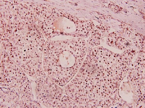 Immunohistochemistry (IHC) analyzes of Netrin-1 (Q533) pAb in paraffin-embedded human liver carcinoma tissue at 1:100