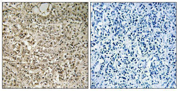 Immunohistochemistry analysis of paraffin-embedded human breast carcinoma tissue, using RPL40 Antibody