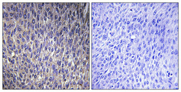 Immunohistochemical analysis of paraffin-embedded Human lung cancer