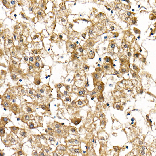 Immunohistochemistry of paraffin-embedded human liver cancer using Smad9 Rabbit pAb  at dilution of 1:100 