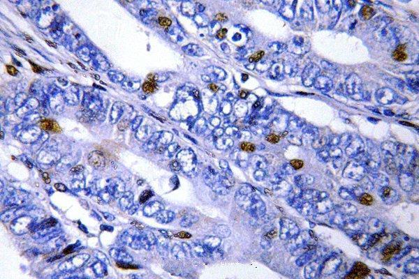Immunohistochemistry (IHC) analyzes of PKA IIβ reg (T109) pAb in paraffin-embedded human cervix carcinoma tissue