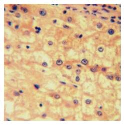 Immunohistochemical analysis of EP2 staining in human liver cancer formalin fixed paraffin embedded tissue section