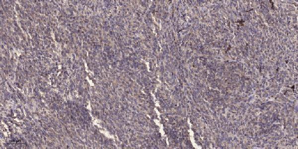 Immunohistochemical analysis of paraffin-embedded human Colon cancer