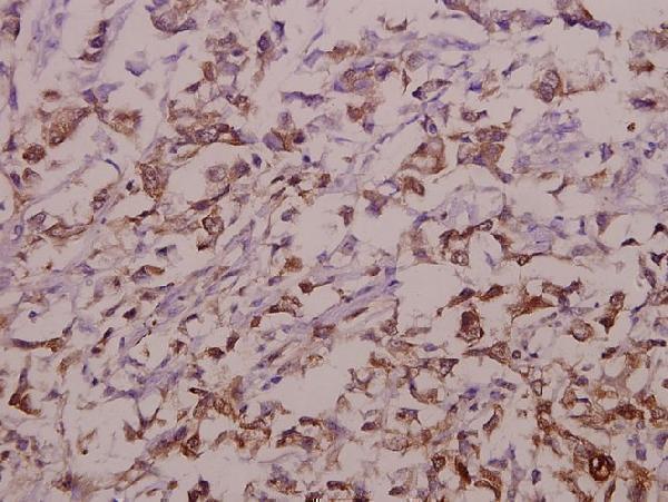 Immunohistochemistry (IHC) analyzes of OATP1 (N286) pAb in paraffin-embedded human colorectal carcinoma tissue at 1:50