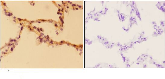 Immunohistochemistry (IHC) analyzes of Aldolase A (T9) pAb in paraffin-embedded human lung carcinoma tissue at 1:50,showing cytoplasmic and nuclear staining