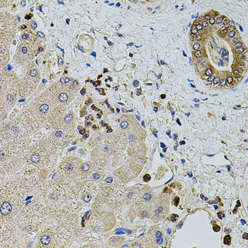 Immunohistochemistry of paraffin-embedded human liver damage using KTN1 antibody  at dilution of 1:100 