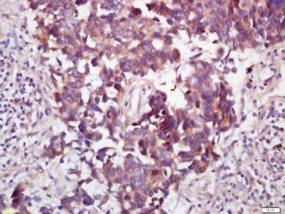 Tissue/cell: human lung carcinoma; 4% Paraformaldehyde-fixed and paraffin-embedded;
Antigen retrieval: citrate buffer ( 0