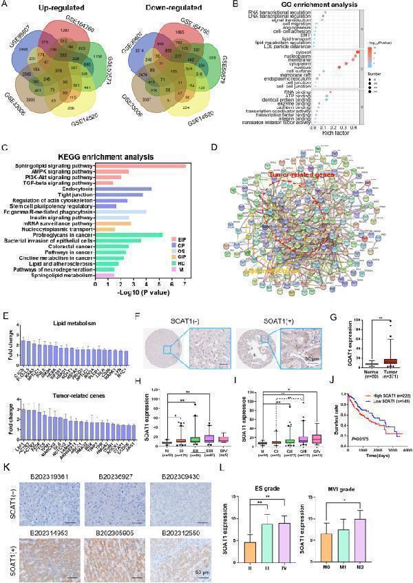 SOAT1 promotes the malignant progression of HCC