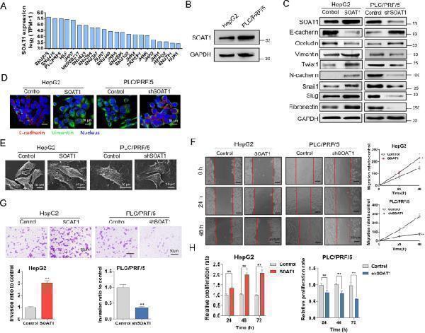 SOAT1 promotes the EMT in HCC cells