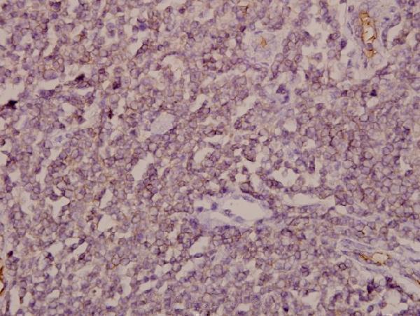Immunohistochemistry (IHC) analyzes of ARF4 (E106) pAb in paraffin-embedded human tonsil carcinoma tissue at 1:50
