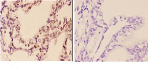 Immunohistochemistry (IHC) analyzes of FXR2 (E576) pAb in paraffin-embedded human colon carcinoma tissue at 1:50,showing cytoplasmic and nuclear staining