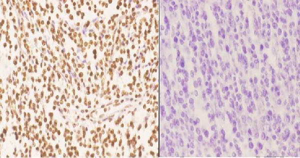 Immunohistochemistry (IHC) analyzes of AKAP8 pAb in paraffin-embedded human tonsil carcinoma tissue at 1:50