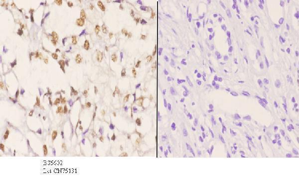Immunohistochemistry (IHC) analyzes of AKAP8 pAb in paraffin-embedded human kidney carcinoma tissue at 1:50
