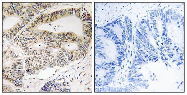 Immunohistochemistry analysis of paraffin-embedded human colon carcinoma tissue, using OSR1 Antibody