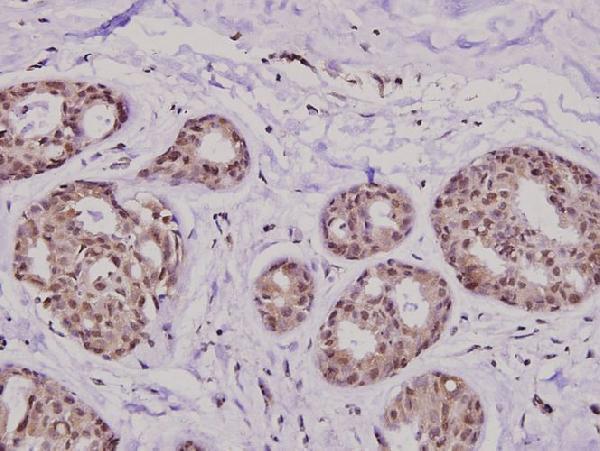 Immunohistochemistry (IHC) analyzes of KIF20A (I524) pAb in paraffin-embedded human breast carcinoma tissue at 1:100