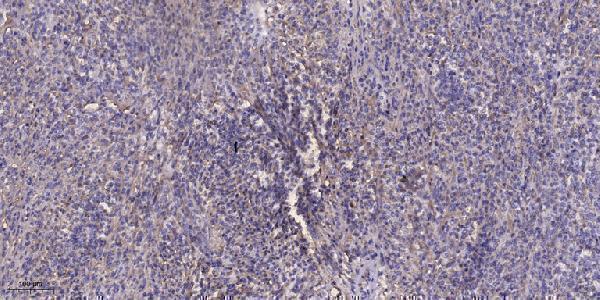 Immunohistochemical analysis of paraffin-embedded human Colon cancer