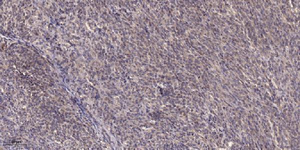 Immunohistochemical analysis of paraffin-embedded human Colon cancer