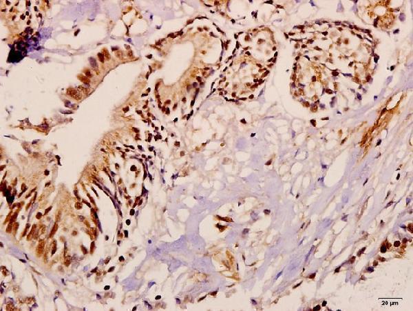 Immunohistochemistry (IHC) analyzes of ME3 (R576) pAb in paraffin-embedded human colorectal carcinoma tissue at 1:50