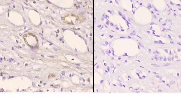 Immunohistochemistry (IHC) analyzes of MOX-2 (N184) pAb in paraffin-embedded human kidney carcinoma tissue at 1:50