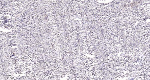 Immunohistochemical analysis of paraffin-embedded human Small intestinal stromal tumor