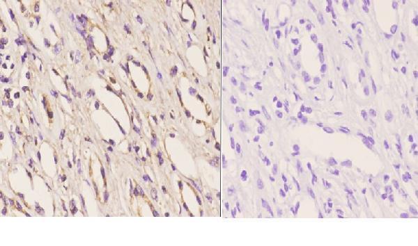Immunohistochemistry (IHC) analyzes of AR-α2C (R369) pAb pAb in paraffin-embedded human kidney carcinoma tissue at 1:50