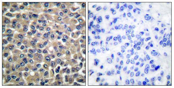 Immunohistochemistry analysis of paraffin-embedded human breast carcinoma tissue, using MMP-19 Antibody