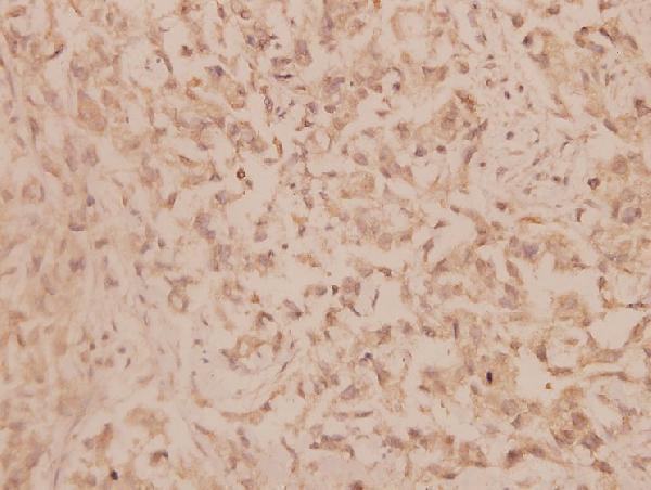 Immunohistochemistry (IHC) analyzes of MMP-19 (G44) pAb in paraffin-embedded human breast carcinoma tissue at 1:100
