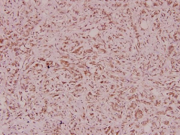 Immunohistochemistry (IHC) analyzes of Defensin α3 (S52) pAb in paraffin-embedded human breast carcinoma tissue at 1:100