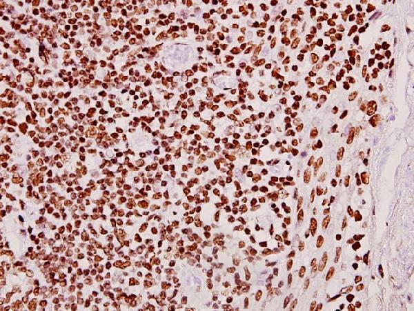 Immunohistochemistry (IHC) analyzes of CLK2 (R15) pAb in paraffin-embedded human tonsil carcinoma tissue at 1:50