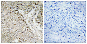 Immunohistochemical analysis of paraffin-embedded Human prostate cancer