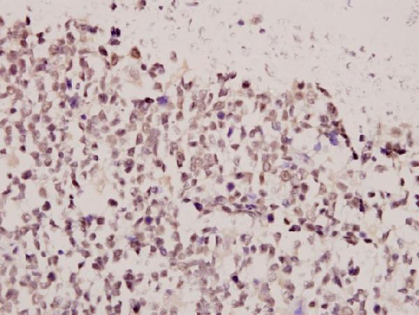 Immunohistochemistry (IHC) analyzes of FoxE3 (R97) pAb in paraffin-embedded human tonsil carcinoma tissue at 1:50